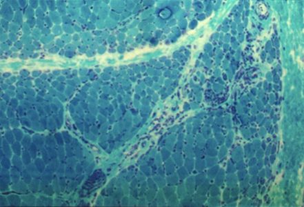 Dermatomyositis Dermatomyositis Trichrome stain with perifascicular atrophy