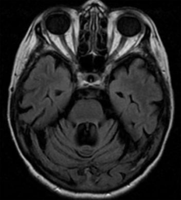 Phenytoin Cerebellar Atrophy Phenytoin Cerebellar Atrophy on T2 FLAIR MRI axial image