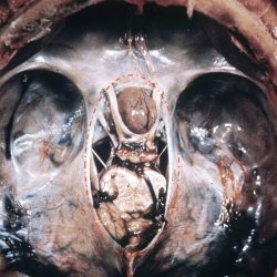 Pituitary Adenoma Pituitary Adenoma Compressing the Optic Chiasm on gross pathology
