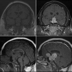 Pituitary Macroadenoma Pituitary Macroadenoma on coronal and sagittal MRI