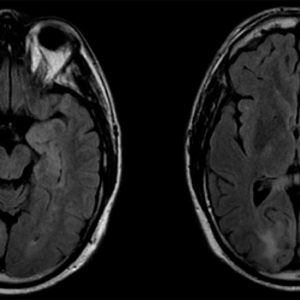 Progressive Multifocal Leukoencephalopathy (PML) Progressive Multifocal Leukoencephalopathy on brain MRI