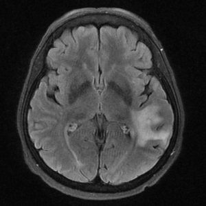 Progressive Multifocal Leukoencephalopathy (PML) Progressive Multifocal Leukoencephalopathy on brain MRI