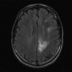 Progressive Multifocal Leukoencephalopathy (PML) Progressive Multifocal Leukoencephalopathy on brain MRI