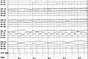 Pulse Artifact EEG with Pulse Artifact