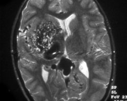 Right Arteriovenous Malformation (AVM) Right arteriovenous malformation (AVM) on MRI AVM