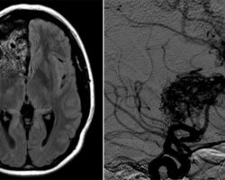 Right Arteriovenous Malformation (AVM) Right arteriovenous malformation (AVM) on MRI and MRA