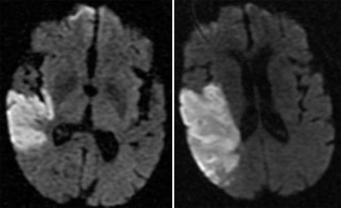 Acute Right MCA Infarct Acute Right MCA Infarct on DWI MRI