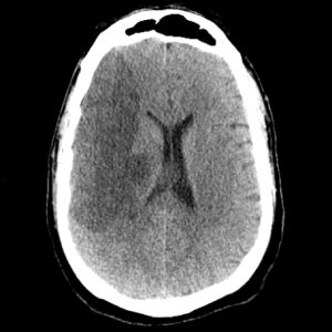 Right MCA Stroke Chronic Right MCA Stroke on axial CT head