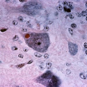 Rabies cytoplasmic Inclusion High power view of the cerebellum showing a Purkinje cell with an eosinophilic inclusion called a Negri body
