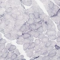 Mitochondrial Myopathy Mitochondrial Myopathy SDH stain showing ragged blue fibers