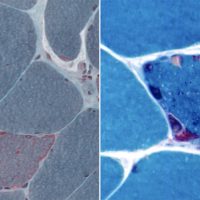 Mitochondrial Myopathy Mitochondrial Myopathy Trichrome and gomori stain showing ragged red fibers