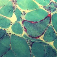 Mitochondrial Myopathy Mitochondrial Myopathy Trichrome stain showing ragged red fibers