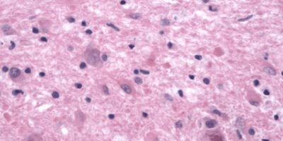 Reactive Astrocytes Reactive Astrocytes on pathology slide
