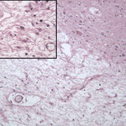 Gliosis after Remote Infarct Gliosis after Remote Infarct seen on neuropathology slide