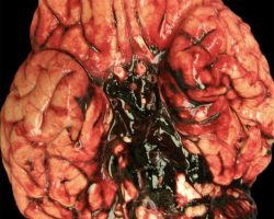 Subarachnoid Hemorrhage in the Circle of Willis Subarachnoid Hemorrhage from Ruptured Berry Aneurysm on gross neuropathology specimen