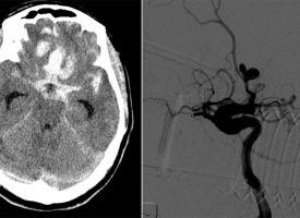 Subarachnoid Hemorrhage from ACA Aneurysm Subarachnoid Hemorrhage from ACA Aneurysm on CT head and angiogram