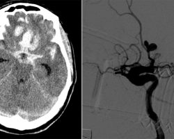 Subarachnoid Hemorrhage from ACA Aneurysm Subarachnoid Hemorrhage from ACA Aneurysm on CT head and angiogram