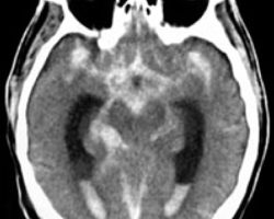 Subarachnoid Hemorrhage with Intraventricular Spread Subarachnoid Hemorrhage with Intraventricular Spread on CTH