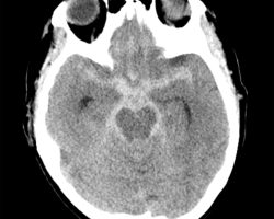 Subarachnoid Hemorrhage with Intraventricular Spread Subarachnoid Hemorrhage with Intraventricular Spread on CT head