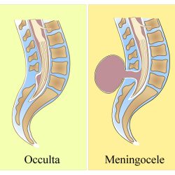Spina Bifida Diagram Spina bifida occulta meningocele and myelomeningocele neurology board study diagram by nowyouknowneuro