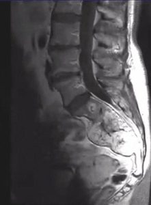Lumbar spine MRI showing a destructive sacrococcygeal lesion suggestive of chordoma Spinal Chordoma on Lumbar spine MRI, sagittal view