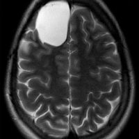 Right frontal arachnoid Cyst Arachnoid Cyst on axial MRI