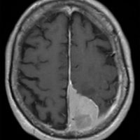 Meningioma Meningioma on axial brain MRI with contrast enhancement