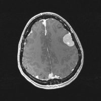 Multiple Meningiomas in NF Type 2 Multiple Meningiomas in NF Type 2 on axial brain MRI