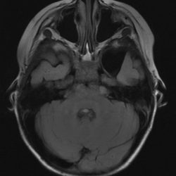 Arachnoid Cyst Arachnoid Cyst on Axial MRI, T2 sequence