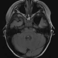 Arachnoid Cyst Arachnoid Cyst on Axial MRI, T2 sequence