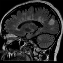 Dawson's Fingers in Multiple Sclerosis Dawsons Fingers in Multiple Sclerosis on T2 FLAIR MRI