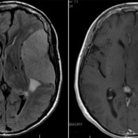 Meningioma Meningioma on axial brain MRI with contrast enhancement