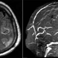 Venous Thrombosis with Hemorrhagic Infarct Venous Thrombosis with Hemorrhagic Infarct on MRI and MRV