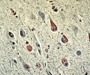Alzheimer's Disease Alzheimer's Disease Tau cytoplasmic tangles on Bodian stain