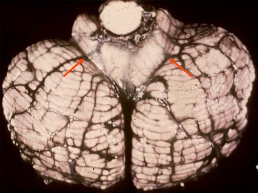 Cerebellar Tonsillar Herniation Cerebellar Tonsillar Herniation on gross neuropathology specimen