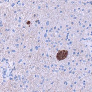 Toxoplasma Cysts Brain biopsy showing toxoplasma cysts with encapsulated bradyzoites