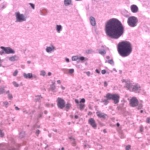 Toxoplasmosis H&E stain showing abundant Toxoplasma tachyzoites (“free-floating” basophilic oval organisms) and bradyzoites (cysts containing protozoa)