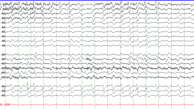 Learn to Read EEG , with practice questions! | NowYouKnow Neuro