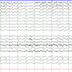 Triphasic Waves EEG tracing with triphasic waves on average montage