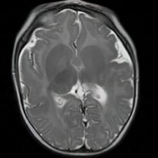 Septo-optic Dysplasia Axial MRI, T2 sequence, showing underdevelopment of the optic nerve and absence of the septum pellucidum in septo-optic dysplasia