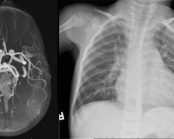 Vein of Galen Malformation Vein of Galen Malformation on MRA and cardiomegaly on CXR