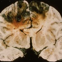 Venous Infarct Venous Infarct caused by a superior sagittal sinus thrombosis shown on gross neuropathology