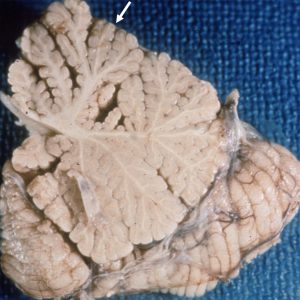 Vermis Atrophy from Alcoholism Pathology specimen with Vermis Atrophy from Alcoholism