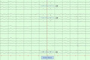 Stage N1 Sleep with Vertex Waves Vertex Wave seen on EEG tracing during Stage N1 sleep