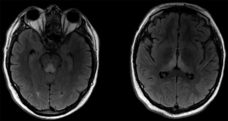 Wernicke's Encephalopathy Wernicke's Encephalopathy on Axial T2 FLAIR MRI showing hyperintensity of the periaqueductal grey and dorsomedial thalamus
