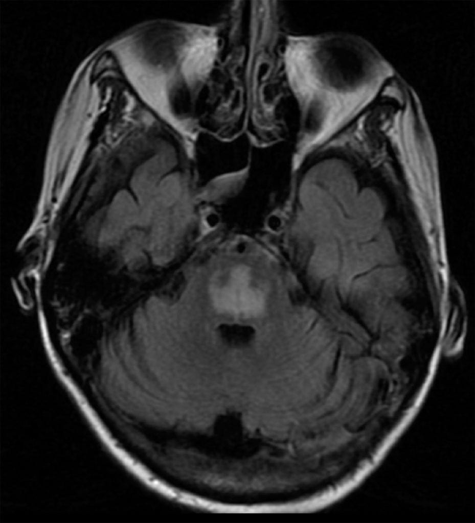 Central Pontine Myelinolysis