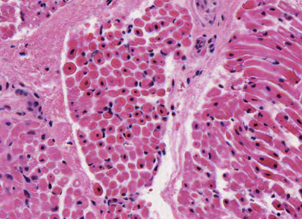 Muscle Pathology Centronuclear Myotubular Myopathy