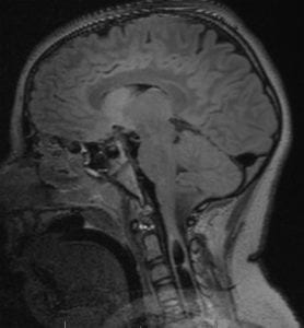 Chiari 1 Malformation with Holocord Syrinx