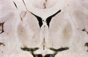 Wilson's Disease