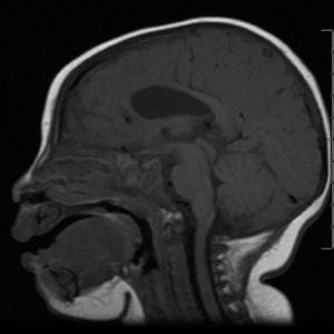 Corpus Collosum Dysplasia